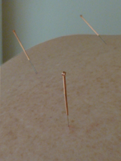 acupunctuur2